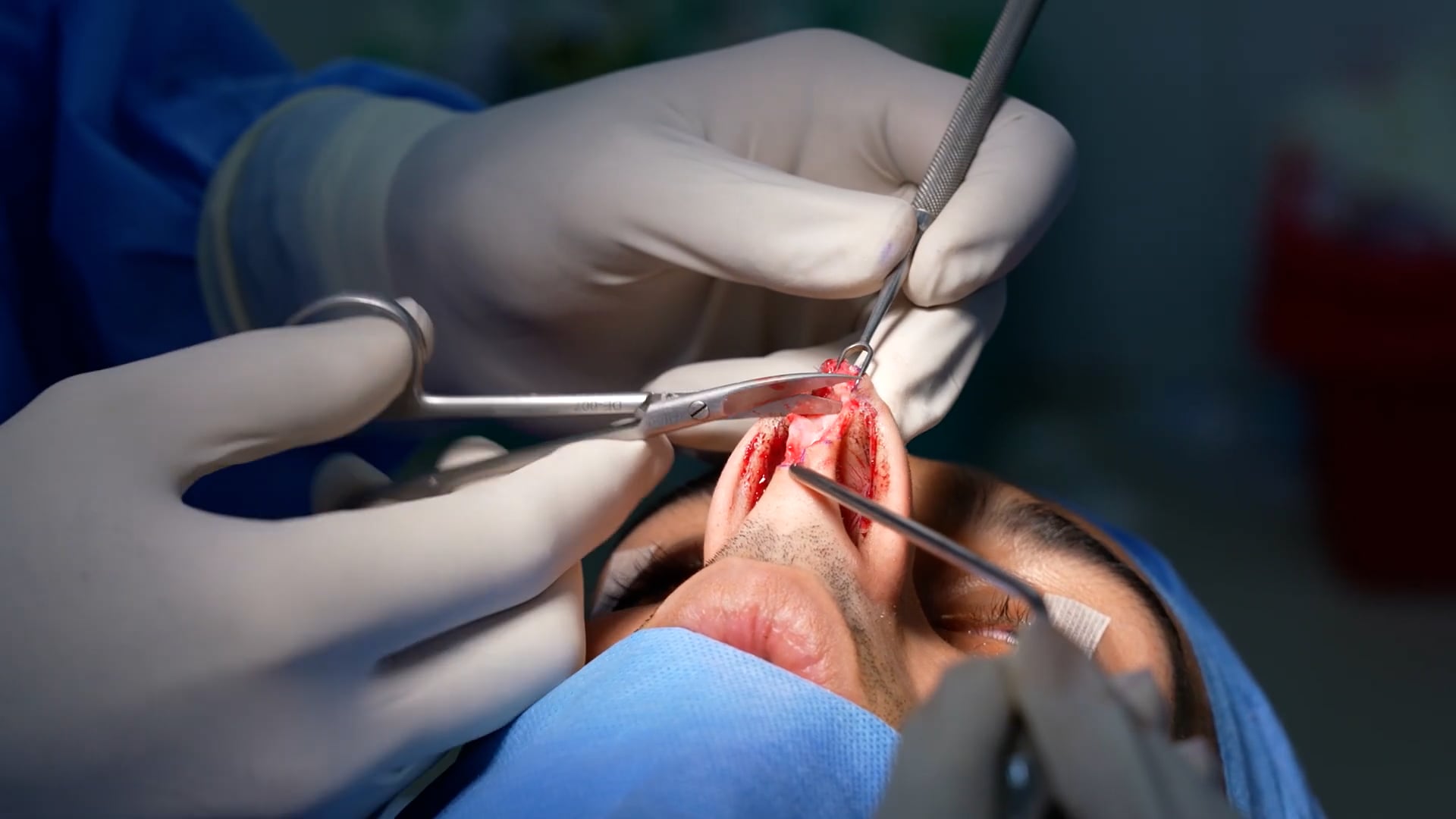 Rhinoplasty Surgery